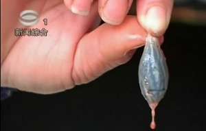 10歲男孩吃魚膽中毒