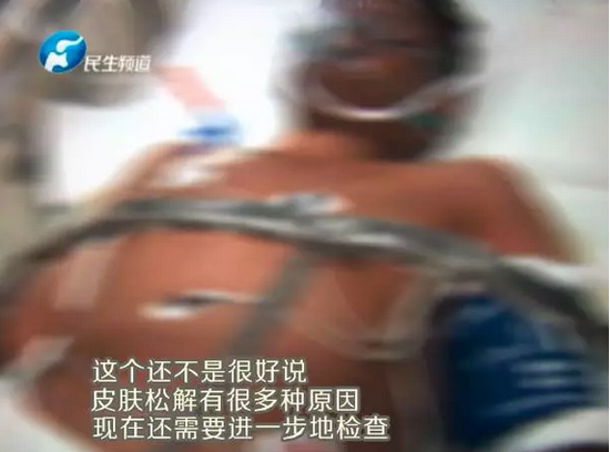 小伙患怪病 感冒吃藥后全身變紫