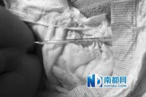 醫院11厘米體溫計插幼童肛門1天 院方稱失誤
