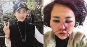 麗江被毀容女子鑒定為輕傷 當(dāng)事人：如何能接受