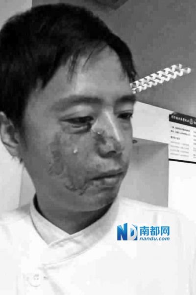 護士小袁眼瞼被砸傷，面部流血。受訪者供圖