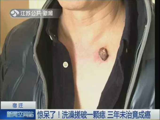 洗澡搓破痣竟成癌 傷口一直沒有好透每次洗澡都會扯破流血
